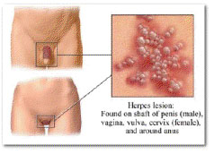 Herpes simplex vírus obrázok 2 